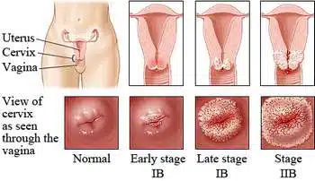 cancer de col uterin imagini