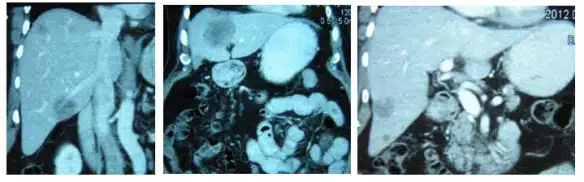 cancerul hepatic diagnosticare cancer la ficat