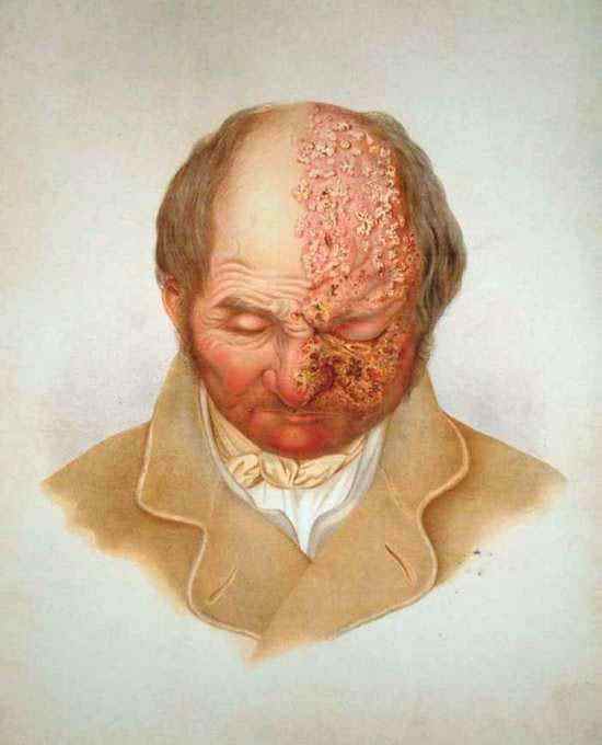 zona zoster - herpes facial