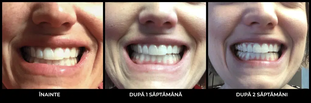 Sugerea uleiului  sau Oil pulling - inainte si dupa